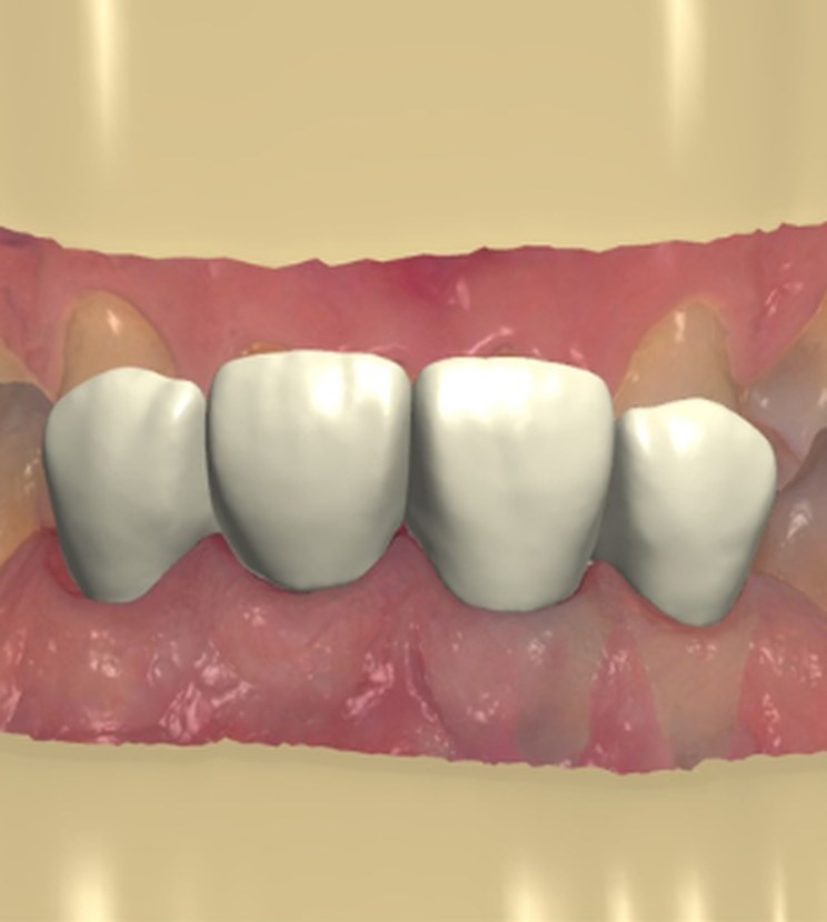 Digital design of four anterior units in a 3D dental model