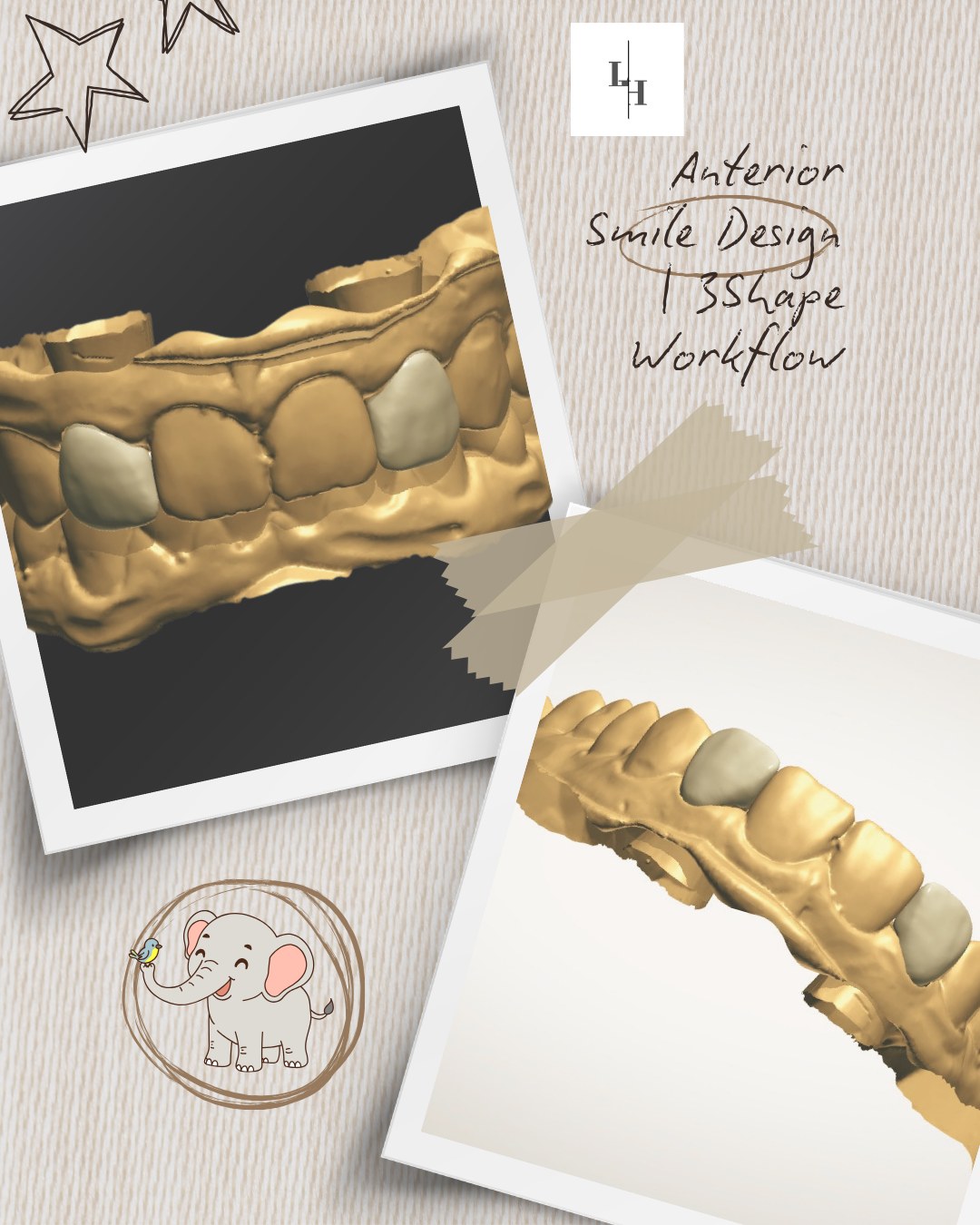 Anterior smile design in the 3Shape workflow, two 3D views