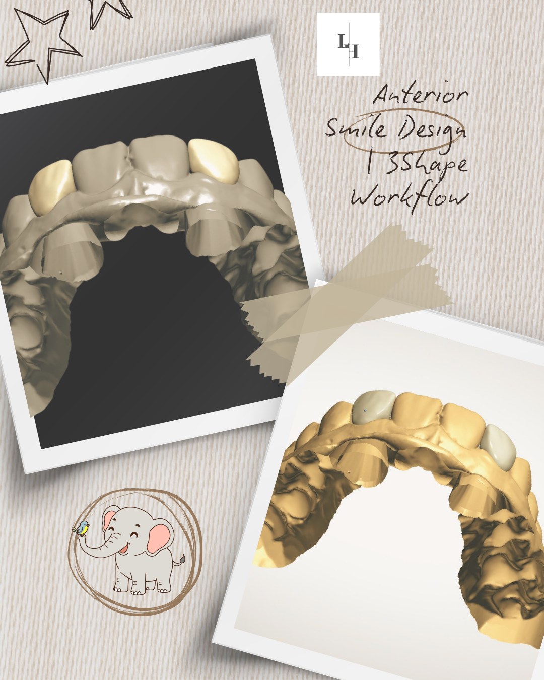 Instagram post: anterior smile design, second 3D view